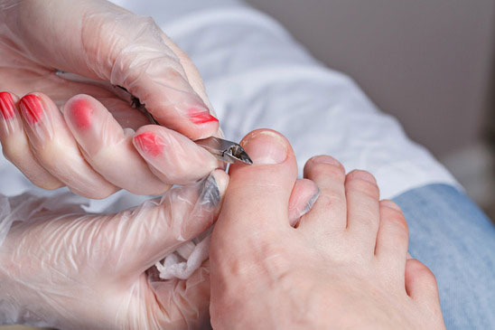 Mobile podiatrist using specialist equipment to treat an ingrowing toenail